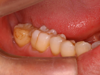 歯牙移植004