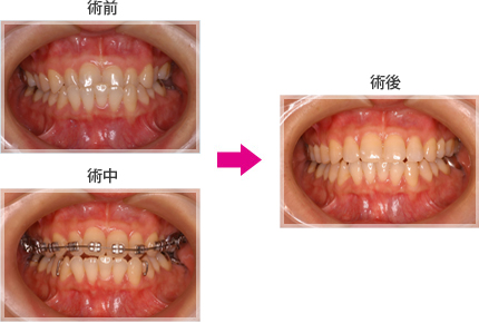 上下逆歯のため下の前歯6本が動いている症例