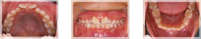 口腔周囲筋機能療法の症例